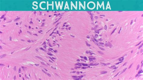 Schwannoma Explained In 5 Minutes Verocay Bodies Antoni A And B Usmle