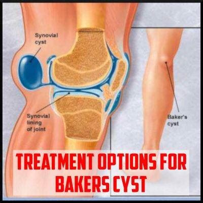Treatment Options For Bakers Cyst Sports Medicine Review