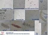 Cellular constituents that may be present in urine include leukocytes, erythrocytes, epithelial cells and sperm. Urine Microscopy and Casts - Image Atlas Key - Squamous ...