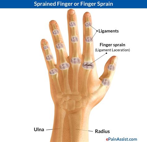 How To Treat A Torn Hand Ligament