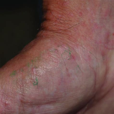 Scabies Burrows After Treatment