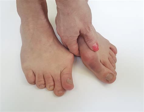 Bunion Pain And Your Treatment Options Northwest Surgery Center