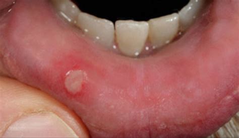 Mouth Ulcers On Tongue