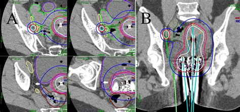 Frontiers Ct Guided Pelvic Lymph Nodal Brachytherapy Oncology