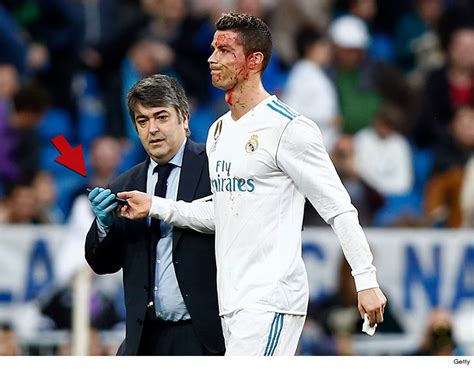 Cristiano Ronaldo Checks Bloody Face With Phone After Head Injury