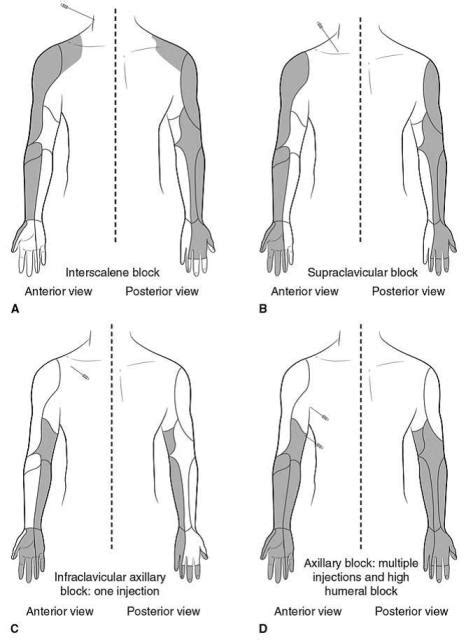 Peripheral Nerve Blocks In Upper Extremity Surgery Orthogate