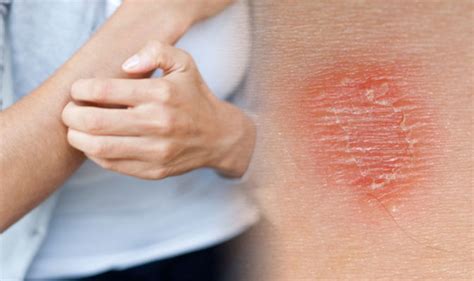 Itchy Skin Four Causes Of Irritation If You Also Have A Rash And What Treatment To Use
