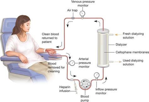 What Is Dialysis Quora