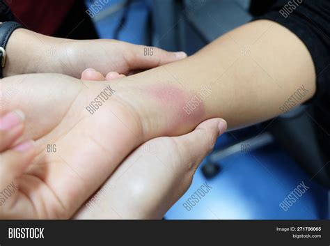 Bruise On Woman Wrist Image And Photo Free Trial Bigstock
