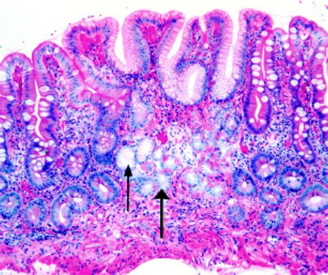 Heterogeneity Of Gastric Histology And Function In Food Cobalamin