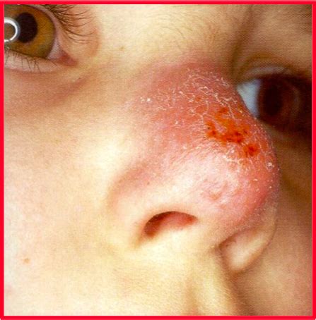 Vijeku cazenave, učenik francuskog dermatologa bietta, uvodi pojam eritemski lupus i potvrđuje da se on razlikuje od ostalih ulceracija kože. lupus vulgaris - Google Search | Lupus awareness, Systemic ...
