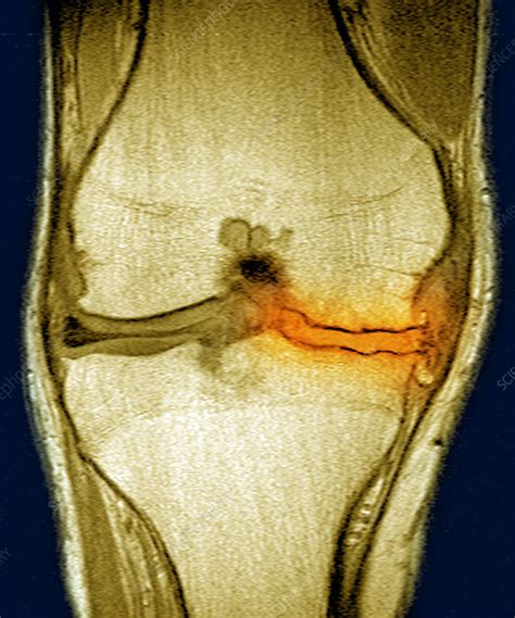 Knee Arthritis Mri Stock Image C0271375 Science Photo Library