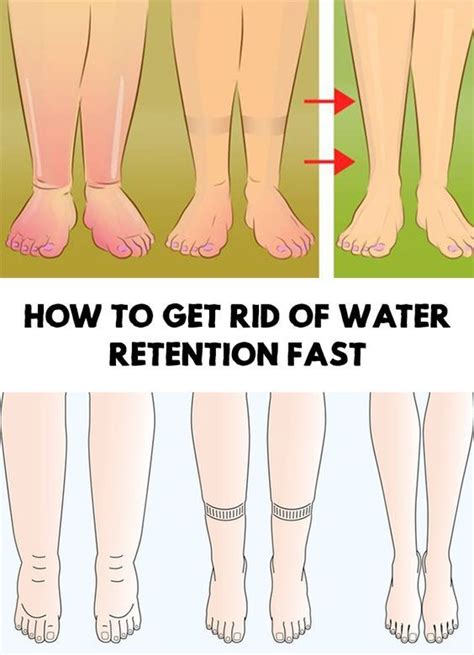 You can often treat the symptoms of swelling that occurs on both sides of your body yourself, dr. How to Get Rid of Water Retention Fast | Swollen feet ...