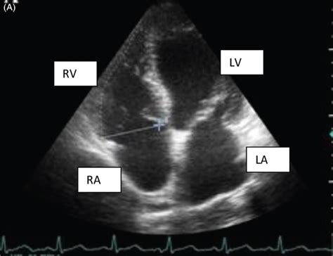 Normal Rv Lv Ratio Echocardiography Sema Data Co Op