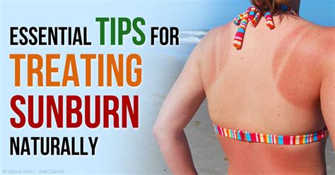 Essential Tips On How To Treat Sunburn