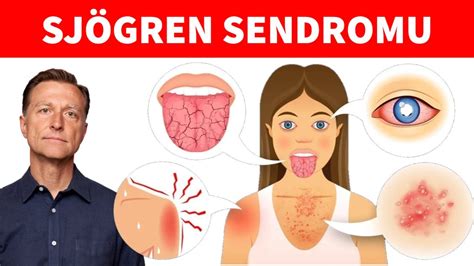 Sjögren Sendromu İçin En İyi Tedavi Protokolü Drberg Türkçe Youtube
