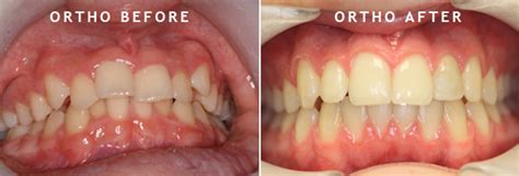 However, it is recommended that an. How to Fix Crooked Teeth - Treatment for Crooked Teeth in ...