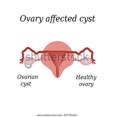 Cyst Ovary Pelvic Organs Vector Illustration Stock Vector Royalty Free