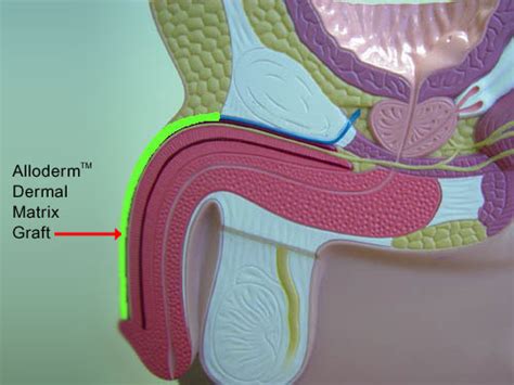 Well, you wanted to increase your penile girth, right? Urología Peruana: Dr. Susaníbar: Engrosamiento peniano: el ...