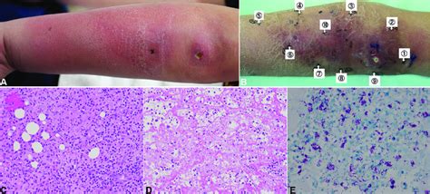 A Initial Clinical Presentation Diffuse Edematous Erythema With