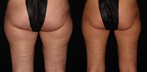 CoolSculpting Before And After Pictures Case Chico Yuba City Oroville CA Hodari MD