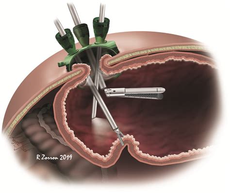 Intragastric Single Port Surgery An Innovative And Multipurpose