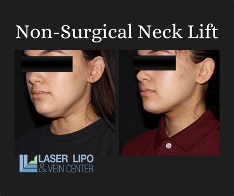 Check Out An Unbelievable Neck Lift Transformation Laser Lipo And