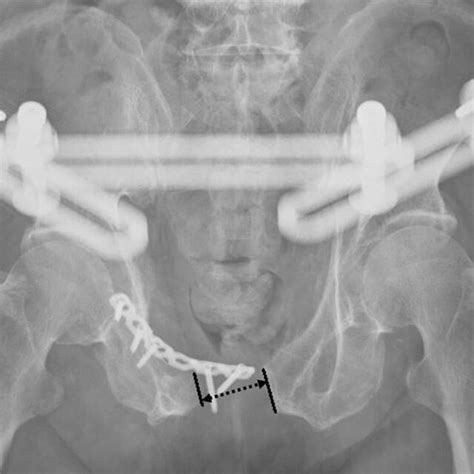 Implant Failure With Loss Of Reduction Showing A Pubic Symphysis