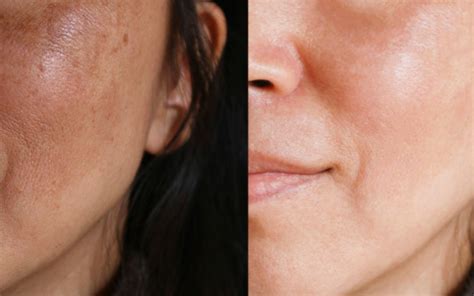 Uneven Skin Texture Causes And Treatment Dr Peter Kay