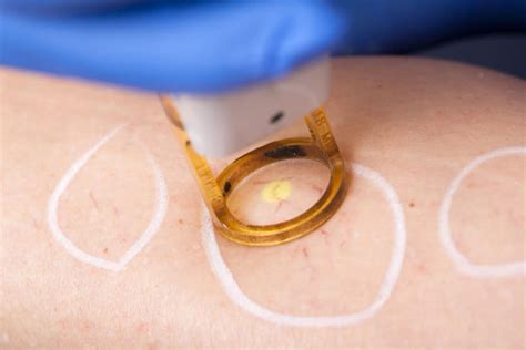 Vascular Laser Treatments Dermetics