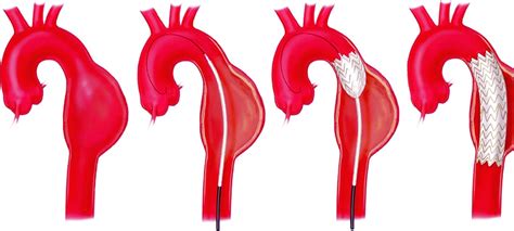 Aortic Aneurysm Definition Causes Symptoms Tests And Treatment
