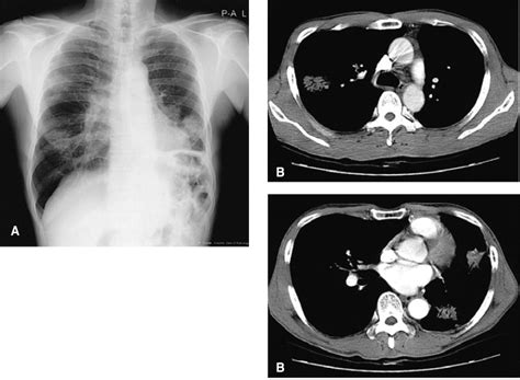 The Plain Chest Radiograph A And Chest Ct Scan B Show Bilateral