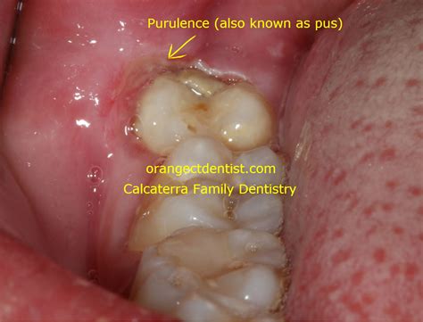 Can You Get Pericoronitis After Wisdom Teeth Removal Teethwalls