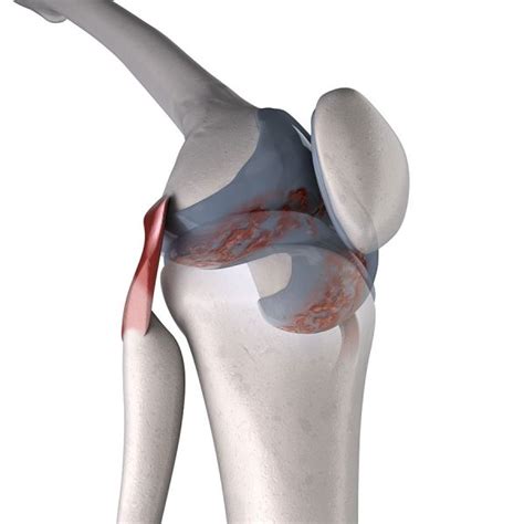 Lateral Collateral Ligament Injury Lcl Tear Or Sprain Knee Experts