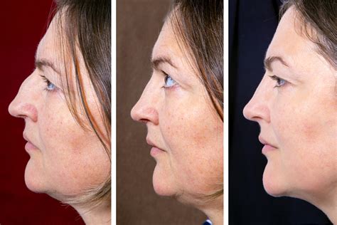 Kybella® A Revolutionary New Treatment For Double Chin Mcrae Md