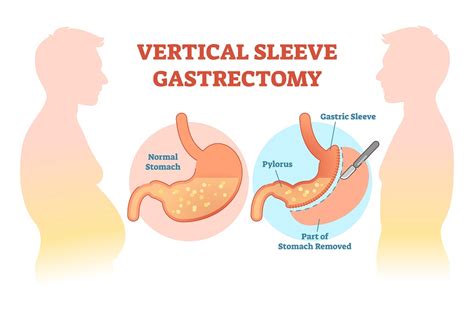Gastric Sleeve Surgery Is Vertical Sleeve Gastrectomy Right For You