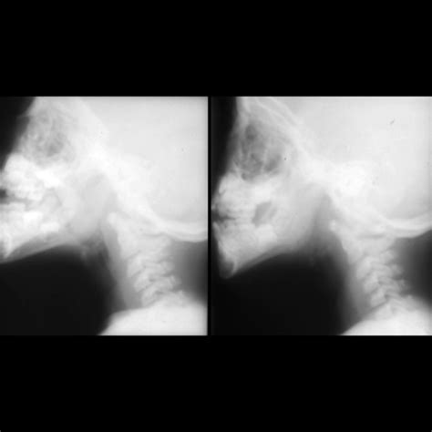 Adenoid Tonsillar Hypertrophy Pediatric Radiology Reference Article