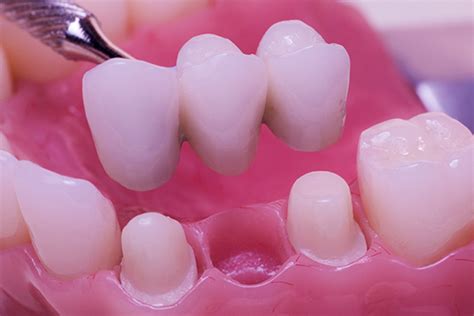 3 Reasons To Replace Missing Teeth With A Dental Bridge Gk Dental Pc