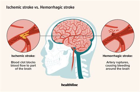 Ischemic Vs Hemorrhagic Stroke