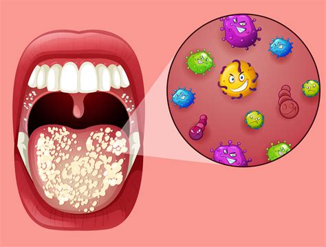 Human Mouth With Oral Thrush 301558 Vector Art At Vecteezy