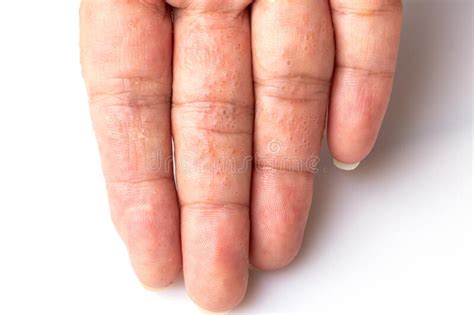 Fechar Dermatite Atópica No Dedo E Também Conhecida Como Conceito De