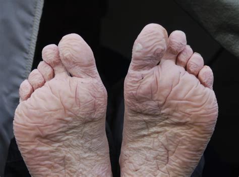 Trench Foot Symptoms Causes Treatment