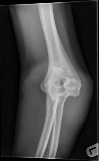 Elbow Dislocation Trauma Orthobullets Bonnie P Gregory Md Elbow