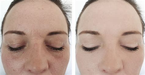 Woman Wrinkles Face Before And After Procedures Toronto Med Spa