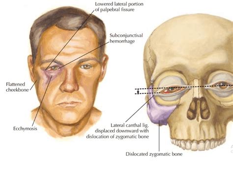 Facial Fractures Maxillofacial