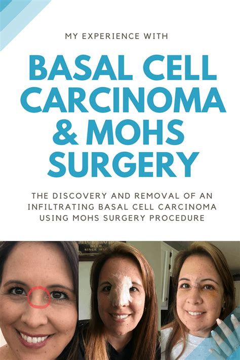 Basal Cell Carcinoma Mohs Surgery Moscato Mom