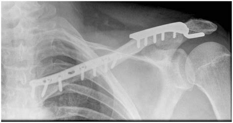Segmental Clavicle Fracture And Acromio Clavicular Joint Disruption An