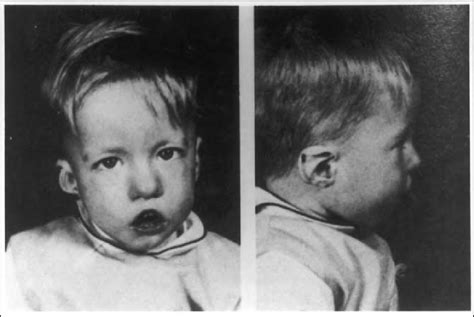 Characteristic Facial Features Of Digeorge Syndrome Including