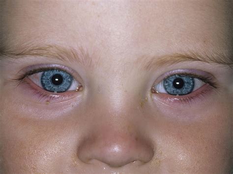 Cancer symptoms and signs depend on the specific type and grade of cancer; Pinkeye (conjunctivitis) in babies | BabyCenter
