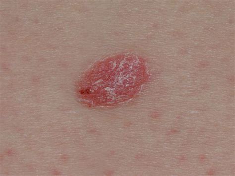 Psoriasis Or Skin Cancer How To Tell The Difference